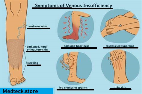 Symptoms of Venous Insufficiency, medteck.store